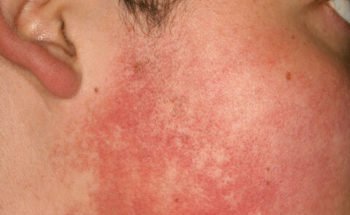 Ulerythema-wang-350x215.jpg
